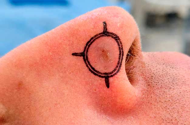 Marcação de uma lesão de pele para Cirurgia Micrográfica de Mohs
